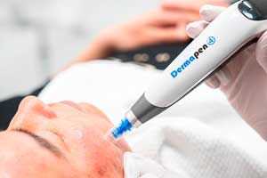 Что такое Дермапен (DermaPen)